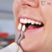 Porcelain Veneers
