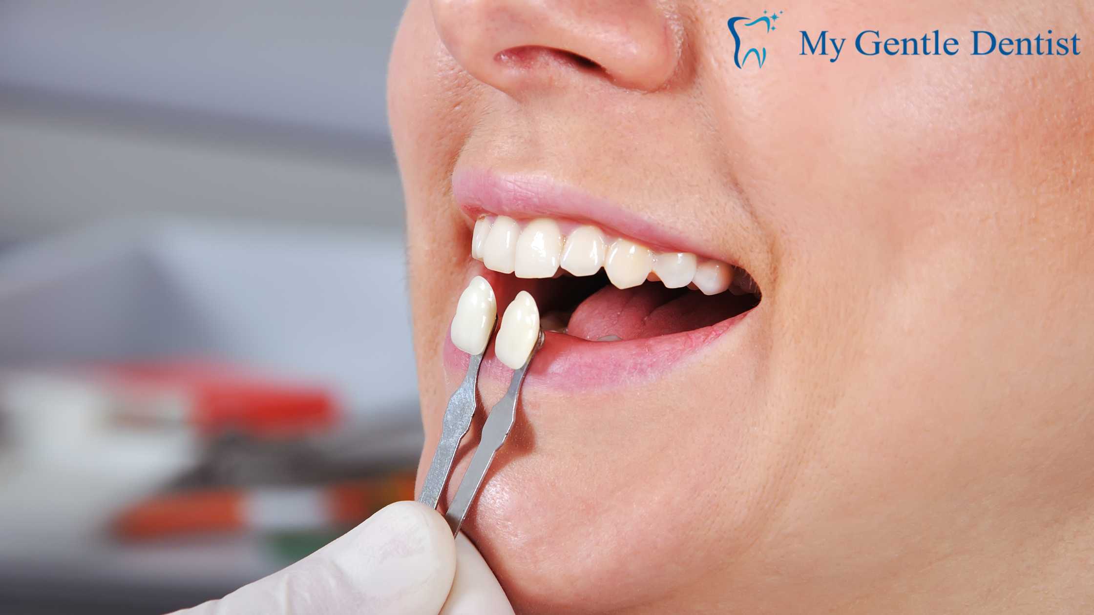 Porcelain Veneers