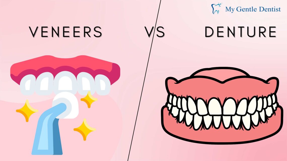 Veneers vs. Dentures
