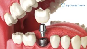 Dental Implants Cost