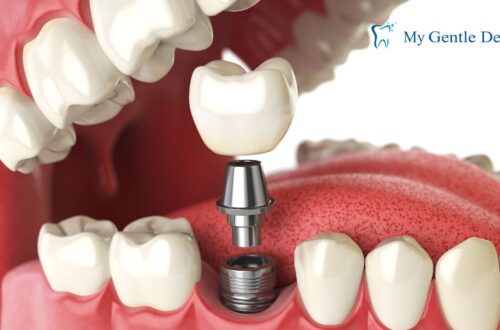 Dental Implants Cost