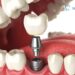 Dental Implants Cost
