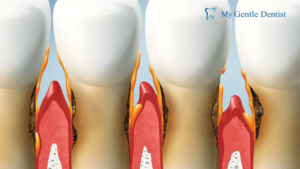 Periodontists Treatments