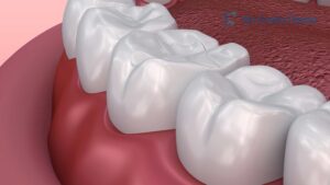 Dental Sealants