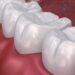 Dental Sealants