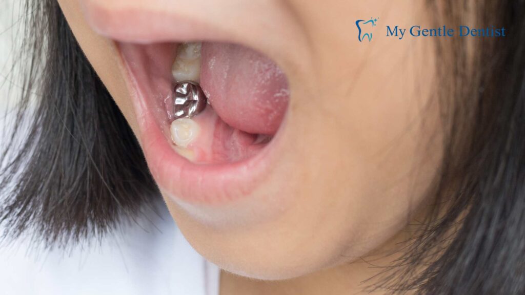 Dental Sealants