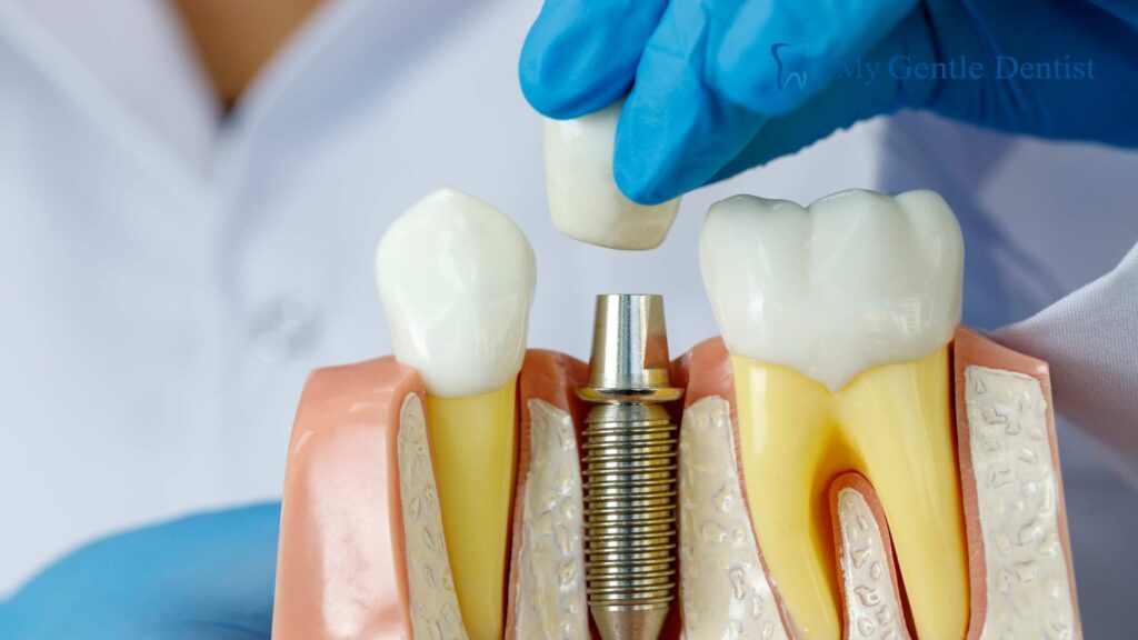 Dental Implants