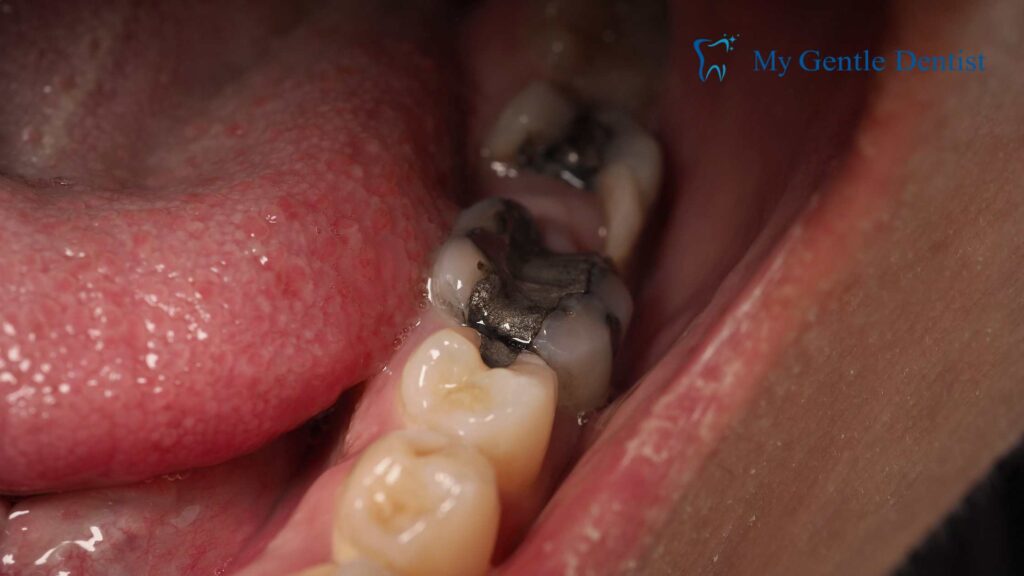 Tooth Decay