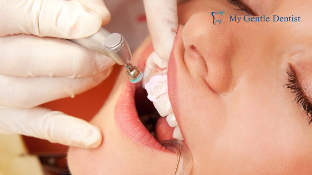 Dental Sealants