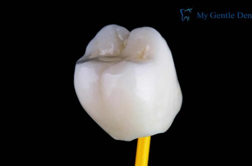 Dental Crown