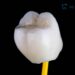 Dental Crown