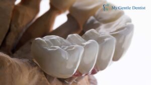 Dental Bridge