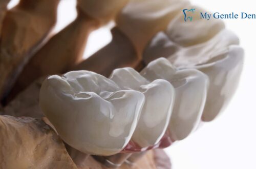 Dental Bridge