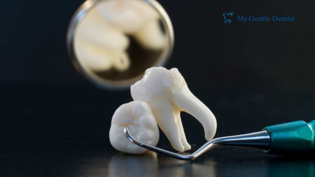 Tooth Extraction