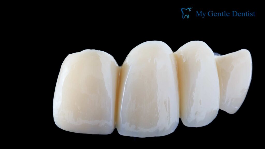 Dental Bridge