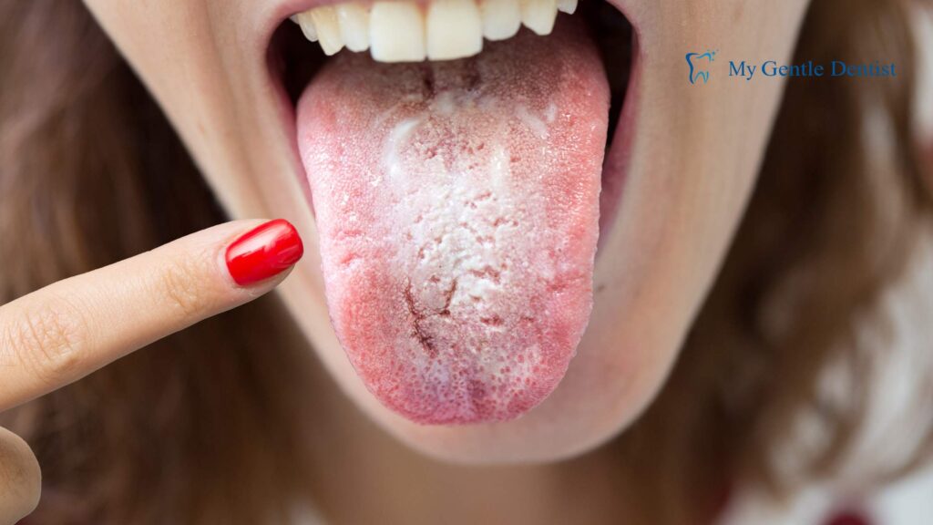Symptoms of Halitosis