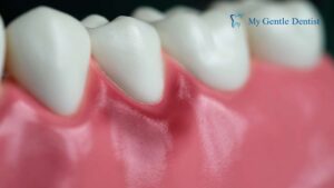 Symptoms of Gingivitis