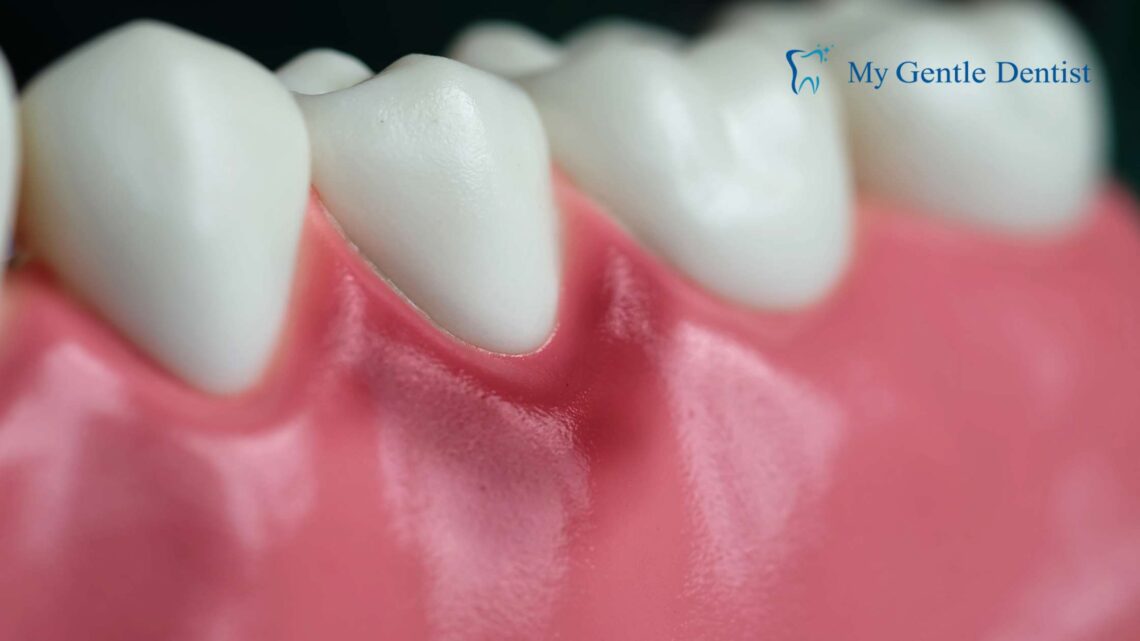 Symptoms of Gingivitis