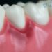Symptoms of Gingivitis