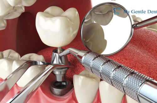 Dental Implants