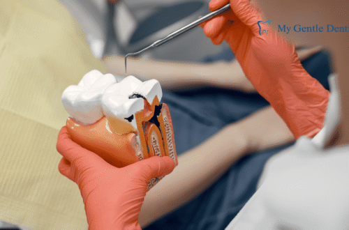 Root Canal