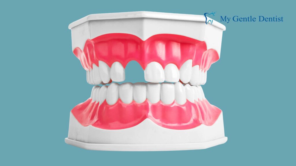 Tooth Loss?
