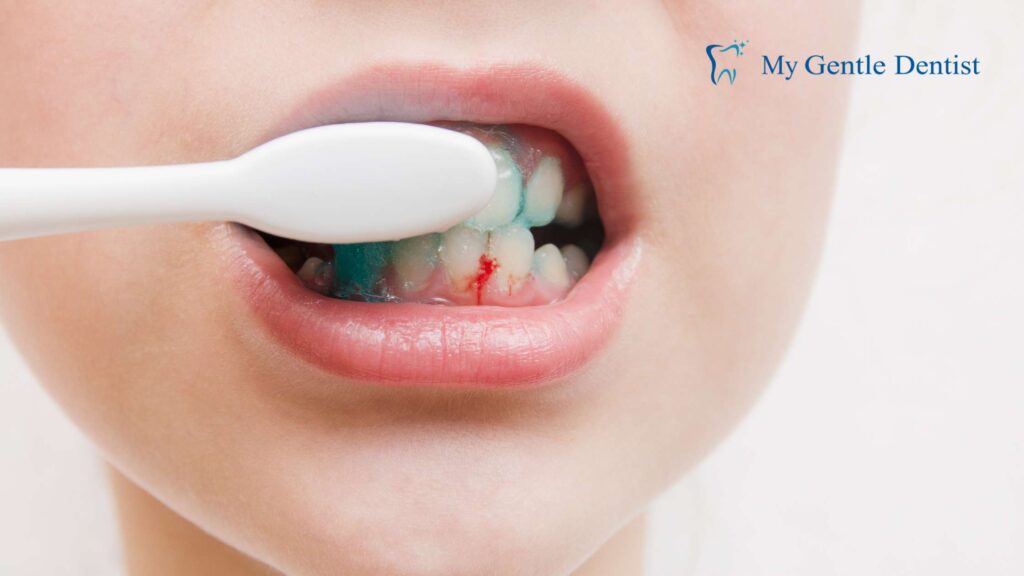 Bleeding Gums During Brushing or Flossing