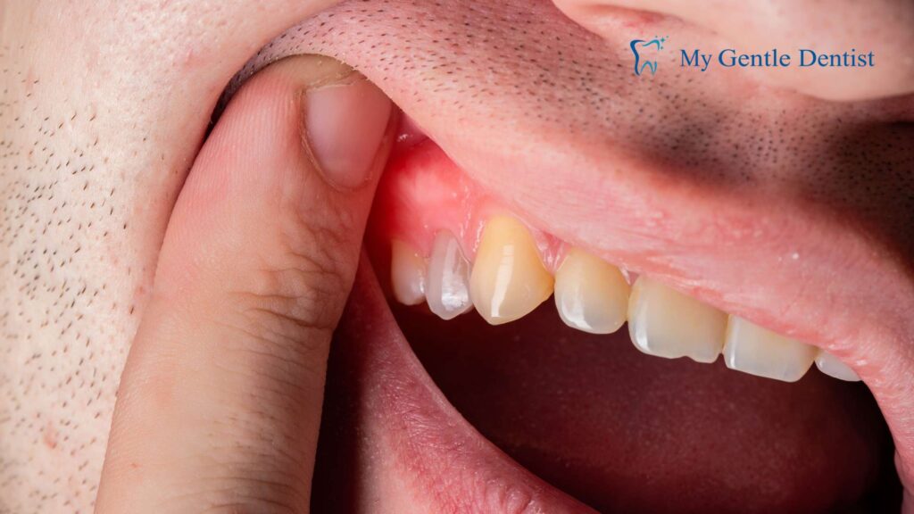Gum Discoloration
