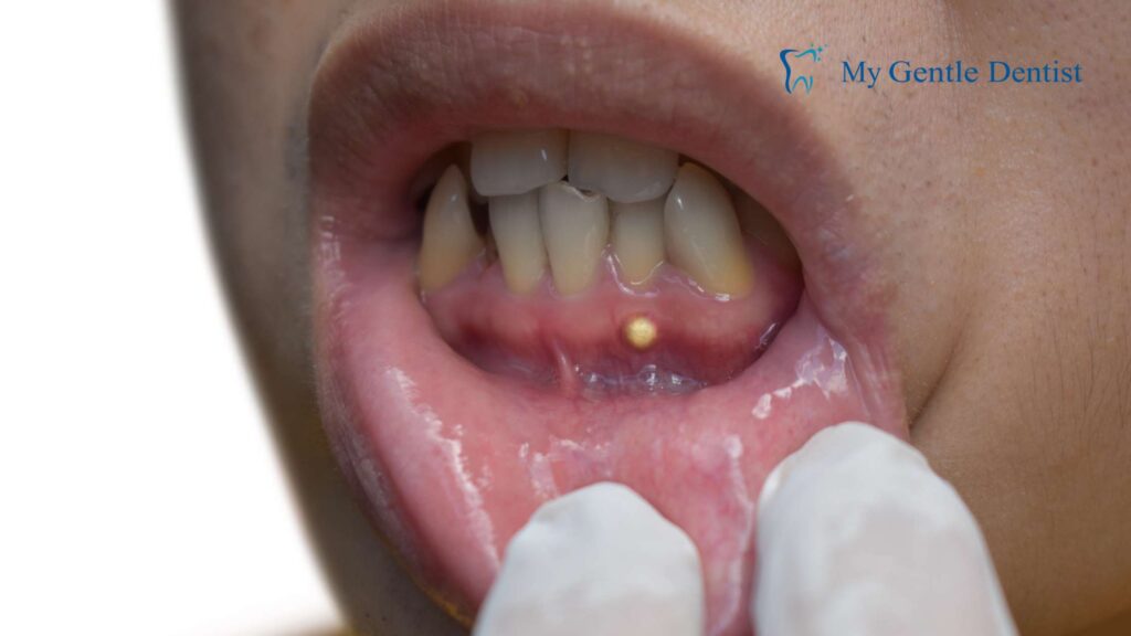 Pus Between Teeth and Gums