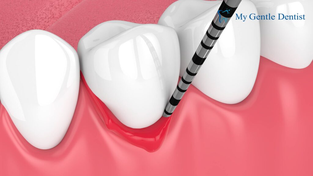 Periodontal Disease