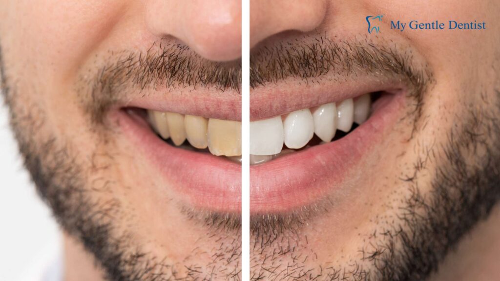 Teeth Whitening