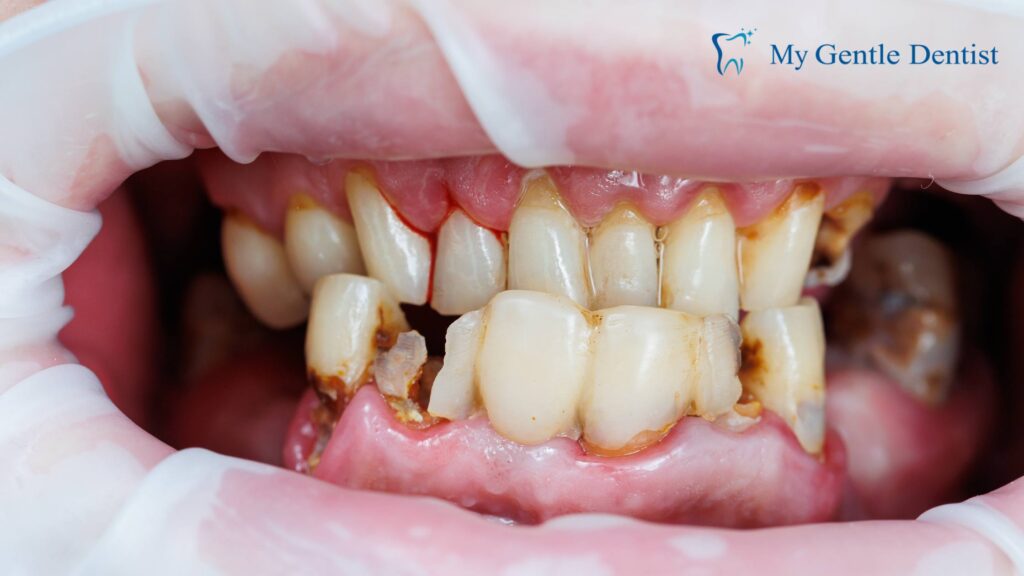 Poor Oral Hygiene