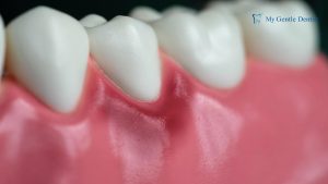 Gingivitis Infection Treatment