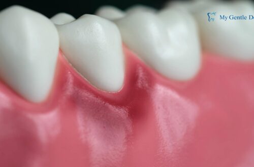 Gingivitis Infection Treatment