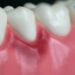 Gingivitis Infection Treatment