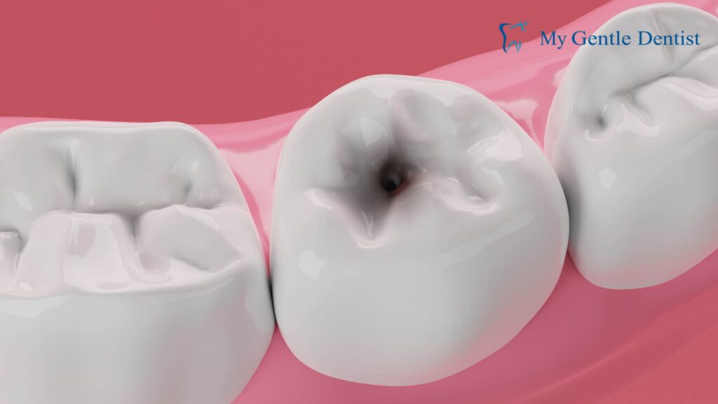 Causes of Toothache