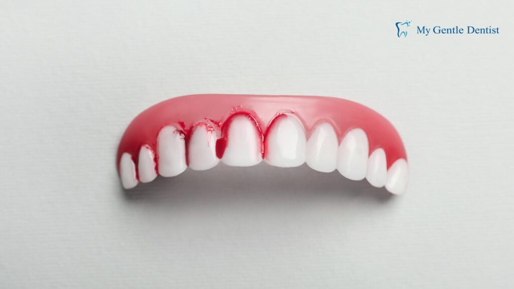 Gingivitis