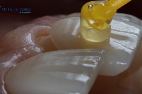 Porcelain Veneers