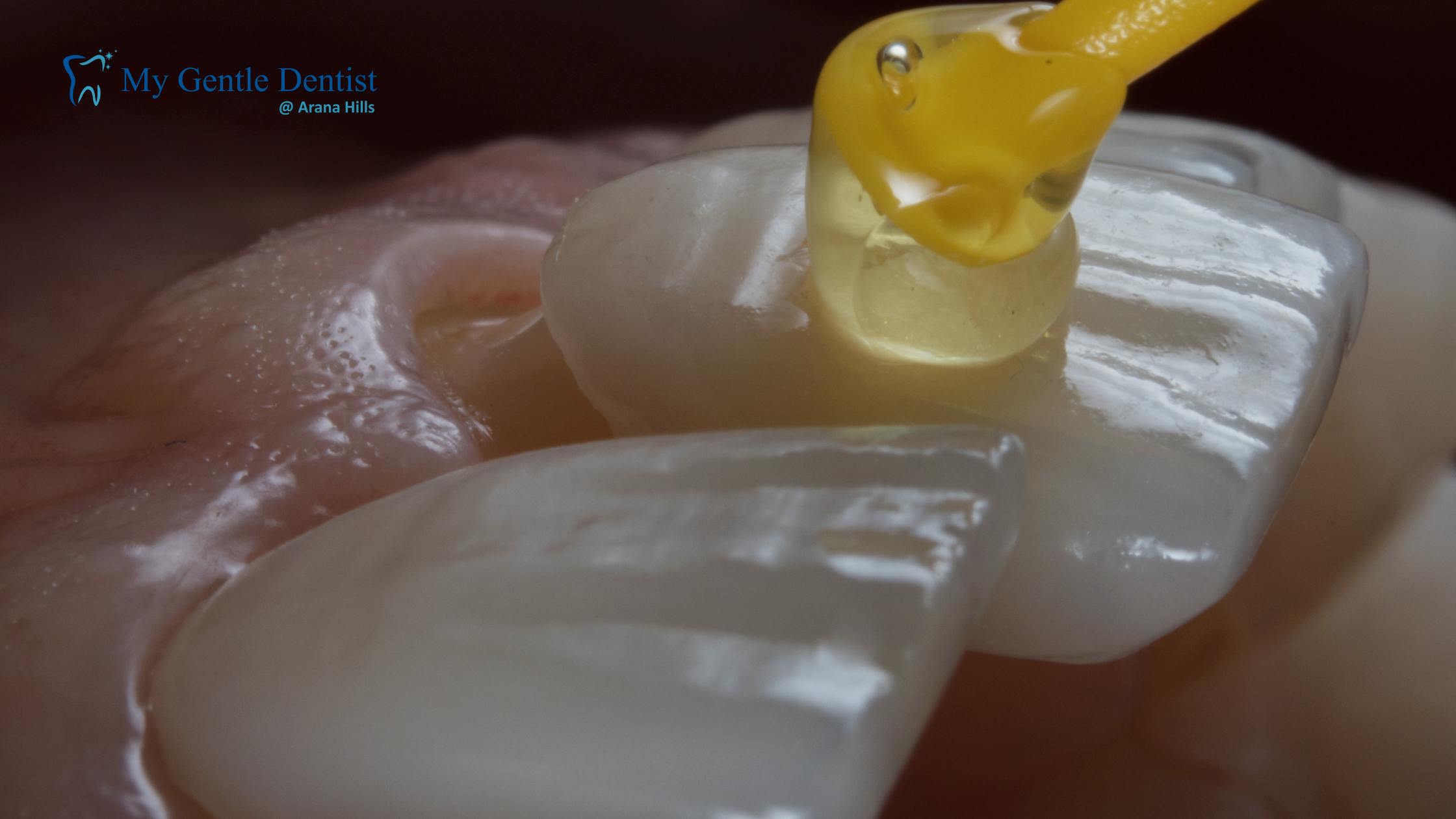 Porcelain Veneers