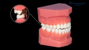 Wisdom Teeth