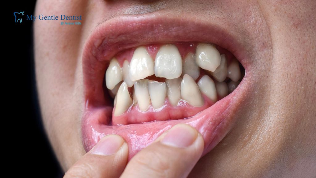 Crooked Teeth