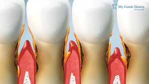 Gum Disease