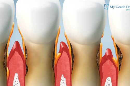 Gum Disease