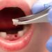 knocked-out tooth