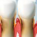 Gum Disease
