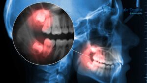 Jaw Stiffness