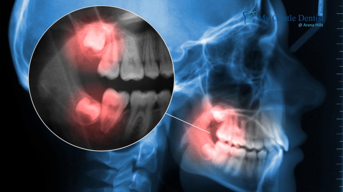 Wisdom Teeth Removal Cost