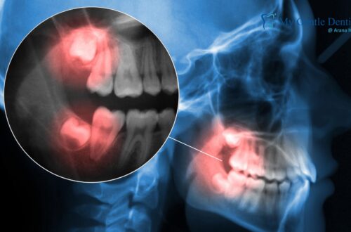Wisdom Teeth Removal Cost