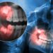 Wisdom Teeth Removal Cost
