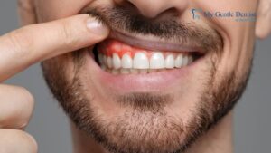 Gum Disease